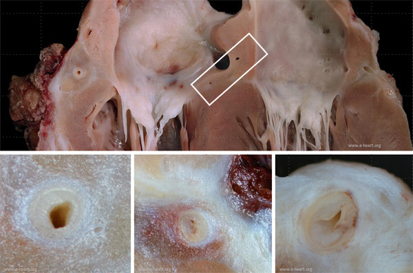 Epicardial coronaries CAV in pediatric patient